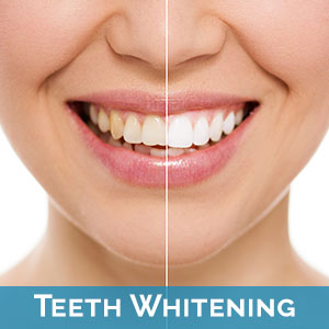 Teeth Whitening in Ramona