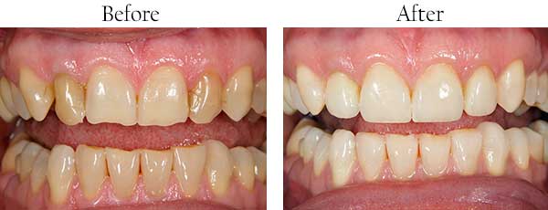 Santa Ysabel Before and After Dental Crowns